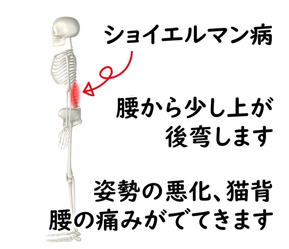 背骨に起こる骨端症の特徴に、姿勢が悪かったり、猫背であったりします。痛みも出てきます。ショイエルマン病という障害名があります